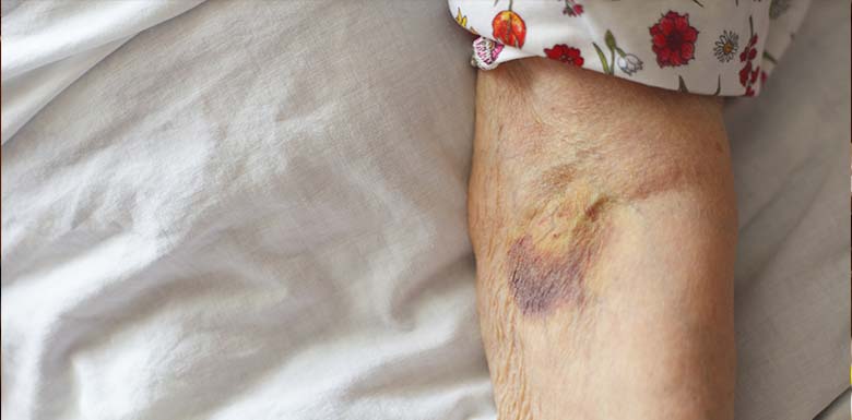 What Can Bruising In The Elderly Tell You About Their Nursing Home Care what-can-bruising-in-the-elderly-tell-you-about-their-nursing-home-care